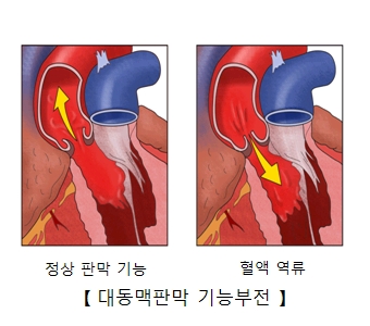 정상 판막 기능과 혈액 역류및 대동맥판막 기능부전의 예시