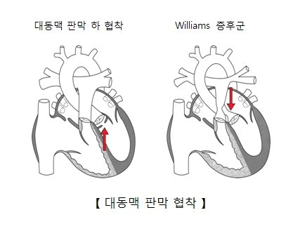 대동맥 판막 하 협착과 Williams 증후군 및 대동맥 판막 협착의 예시