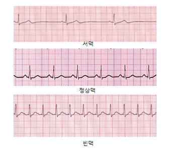 서맥 정상맥 빈맥의 차이