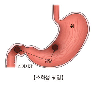 위 궤양 십이지장의 위치및 소화성 궤양의 대한 예시