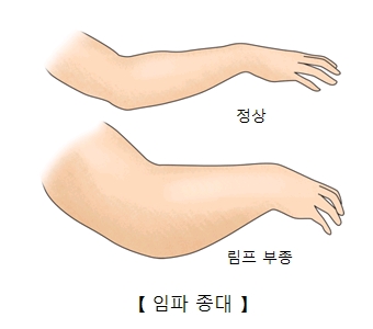 팔 정상부위와 림프부종에 걸린 차이및 임파종대의 예시 