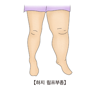 다리쪽 임파종대가 걸린 하지 림프부종의 예시