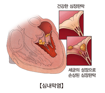 건강한 심장판막과 세균의 성장으로 손상된 심장판막 차이및 심내막염의 예시