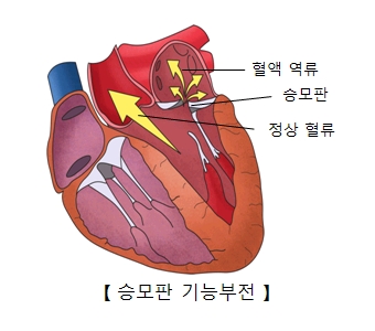 혈액역류 승포판 정상혈류의 위치 및 승모판 기능부전의 예시