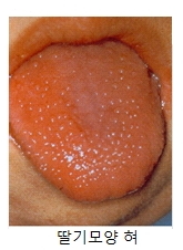 점막피부의 림프절 증후군으로 인한 딸기모양의 혀