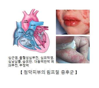 심근염 울혈성심부전 심외막염 심낭삼출 승모판 대동맥판막 예쇄부전 부정맥을 나타낸 이미지와 점막비부의 림프절 증후군을 예시한 유아의 사진