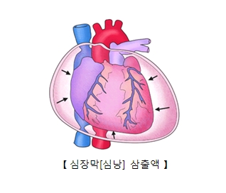 심장막(심낭) 삼축액의 예시