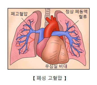 폐 고혈압 정상폐동맥 혈류 이심실 비대 위치및 폐성 고혈압의 예시