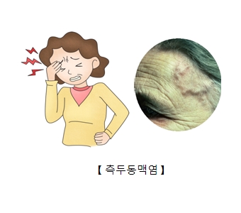 두통을 느끼는 여성및 실제 측두동맥염이 발생한 예시