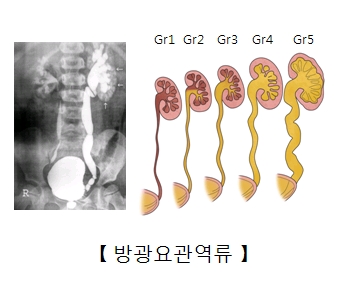 방광요관역류 x-ray사진 및 다섯가지 크기의 방광요관역류 예시