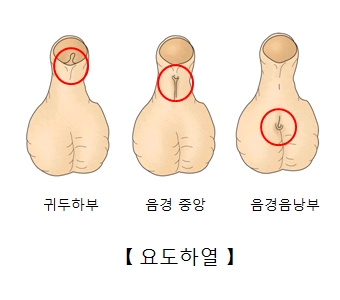 귀두하부 음경중앙 음경음낭부에 나타난 요도하열의 예시