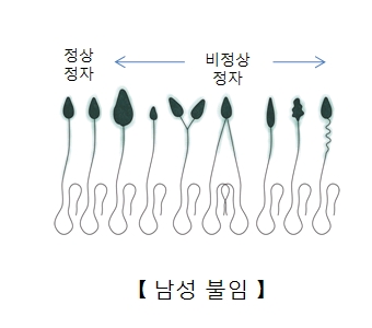 정상정자와 비정상정자의 차이점 및 남성불임의 예시