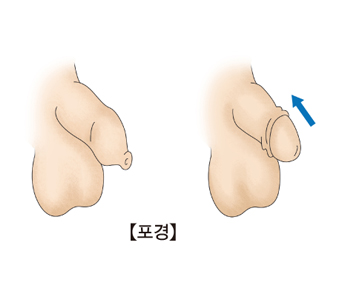 포경의 예시