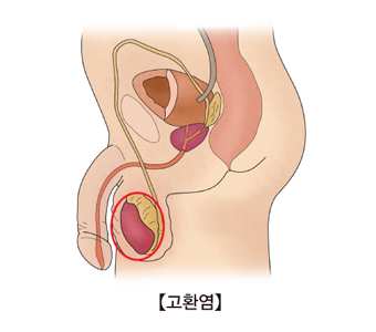 고환염이 발생한 예시