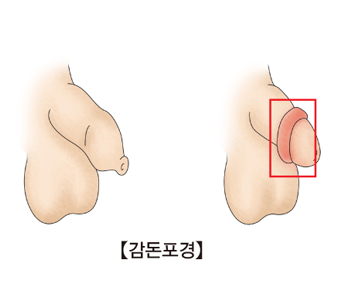 감돈포경의 예시