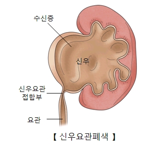 신우 수신증 신우요관접합부 요관등 신우요관폐색의 예시