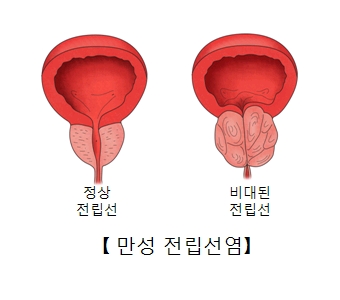 정상 전립선 및 비대된 전립선의 만성 전립선염 예시