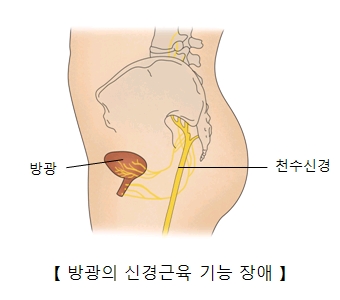 방광 및 천수신경의 위치와 방광의 신경근육 기능 장애의 예시