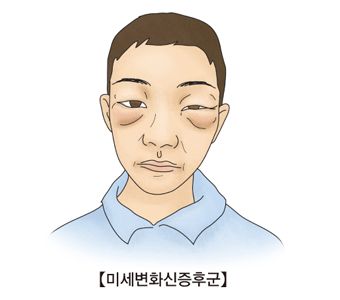 눈 주변에 미세변화신증후군이 발생한 예시