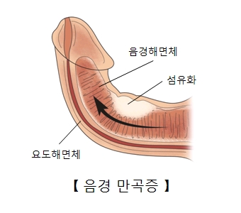 음경해면체 섬유화 요도해면체의 위치및 음경만곡증에 대한 예시