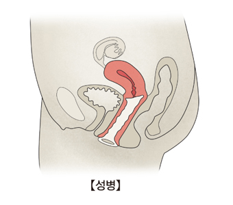 성병에 걸린 여성자궁의 단면도 예시