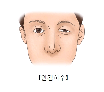 오른쪽 눈은 정상인데 왼쪽 눈의 윗눈꺼플이 아래로 처진 남성의 모습