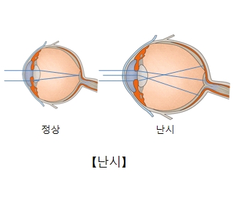 난시일때 사물을 바라보는 사진 예시