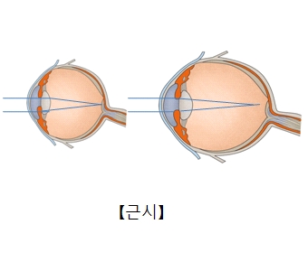 근시일때 사물을 바라보는 사진 예시