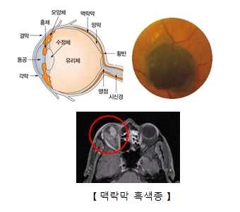 눈의구조 모양체,홍채,결막,동공,각막,맥락막,망막,황반,맹점,시신경,수정체,유리체의 위치 맥락막 흑색종의 CT사진및 종양의 모습