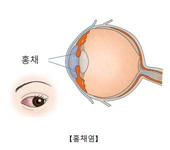 홍채의위치와 홍채염이 발병된 눈의 사진예시