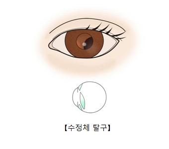 수정체가 이탈된 눈