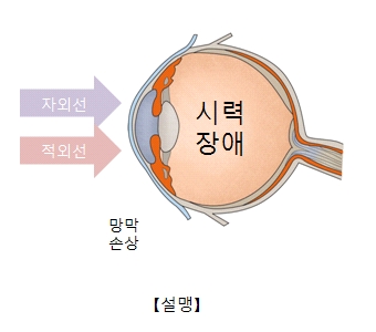 자외선과적외선으로 인해 망막이 손상되어 시력장애(설맹)가 일으킨 사진예시