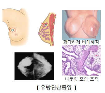 유방엽상종양이 발병하여 과다하게 비대해진 여성의 유방사진과 유방찰영술을통해본 사진및 나뭇잎모양의 조직세포 사진 예시