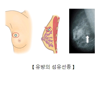 유방의 섬유선종 그림예시및 유방찰영술을 통해본 사진 예시