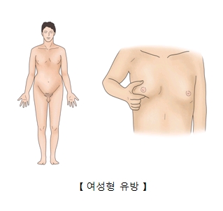 남성의 모습과(오른쪽),여성의 유방처럼된 남성의 가슴