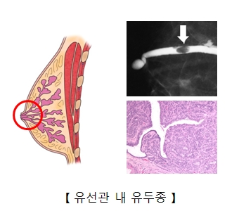 유선관 내 유두종 사진 예시