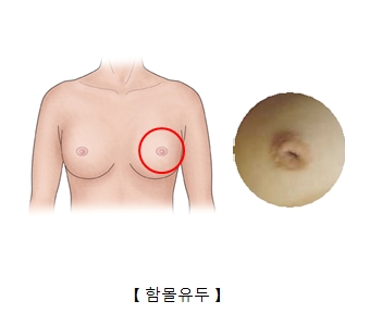 함몰유두의 그림및사진 예시