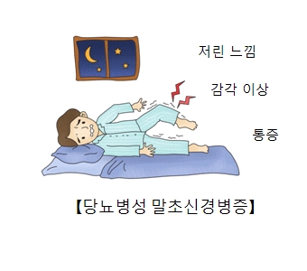 당뇨병성 말초신경병증의 증상-저린느낌,감각이상,통증