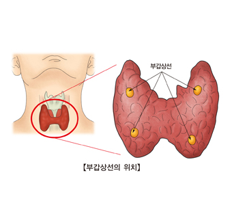 부갑상선의 위치 그림 예시