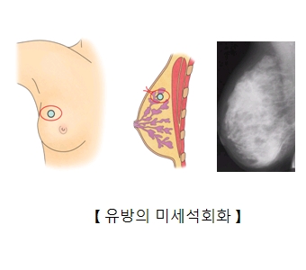 유방의 미세석회화 그림 예시및 유방촬영술로 본 사진 예시