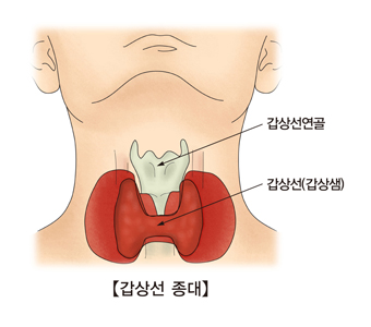 갑상선 종대-갑상선(갑상샘),갑상선연골 위치 