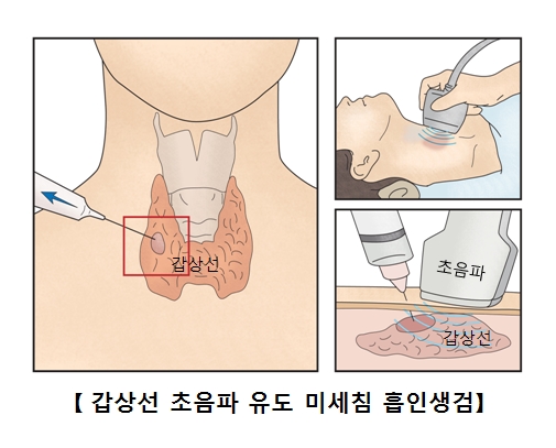 갑상선 초음파 유도 미세침 흡인생검 그림 예시