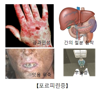 광과민성 간의철분침착 잇몸위축 우울증등 포르피린증의 예시