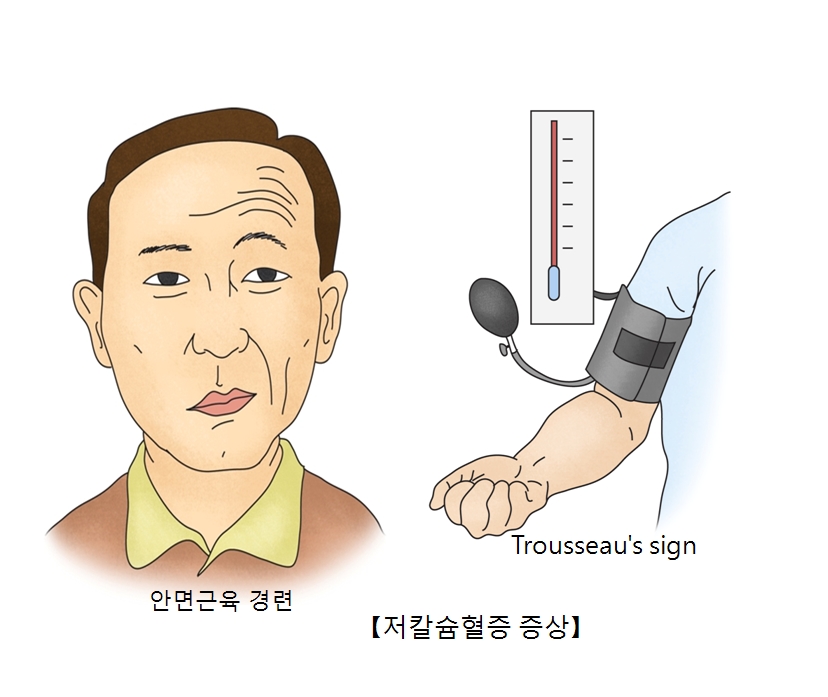 안면근육경련및 Trousseau's sign등 저칼슝혈증 증상의 대한 예시