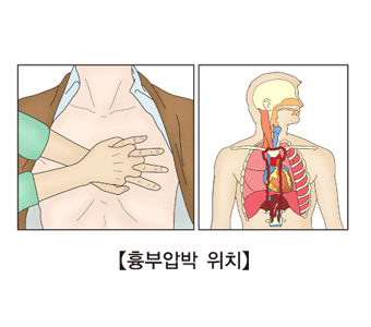 흉부압박법 및 흉부압박위치의 예시