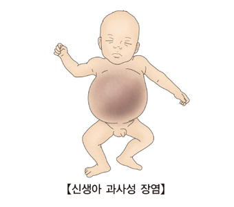 신생아 과사성 장염의 걸린 유아