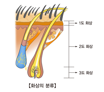 우리 몸에 미치는 1도화상 2도화상 3도화상의 분류된 예시