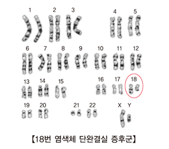 18번 염색체 단완결실 증후군의 대한 예시