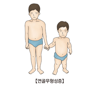 연골무형성증의 걸린 남자아이의 예시