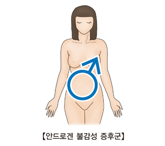 안드로겐 불감성 증후군의 걸린 여성